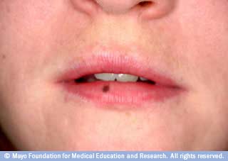 النمشة الشفوية النمشة الشفوية