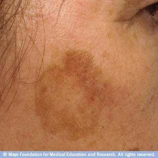 نمشة خبيثة نمشة خبيثة