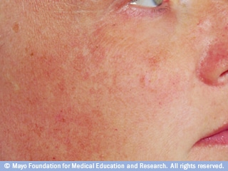 صبغ متفاوتة صبغ متفاوتة