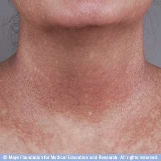 تبكل الجلد تبكل الجلد