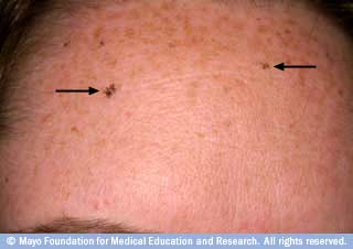 النمش الشمسي على الجبين النمش الشمسي على الجبين