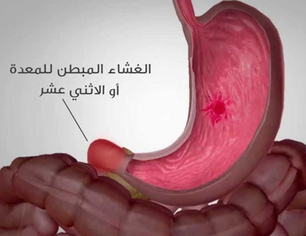قرحة المعدة -أعراض قرحة المعدة ، اسبابها وطرق علاجها