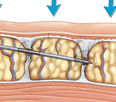 subcision-2-380x335-1 16.حل جراحي :