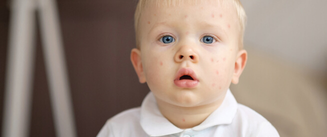 tbl_articles_article_22059_1261734574f-6dab-4728-bce7-897c207e836c الجدري عند الأطفال: معلومات هامة