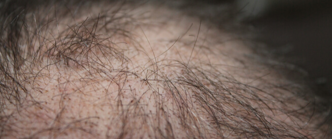 تساقط الشعر الكربي: حزن وحمى وأمور بسيطة قد تفقدك شعرك!