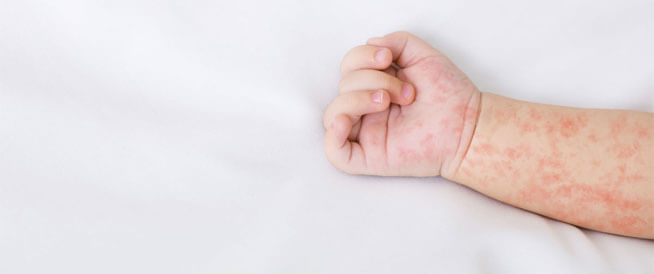 tbl_articles_article_22182_224aa75467-1fef-4124-971b-737d7115cb0e اعراض الحمى الوردية وطرق الوقاية