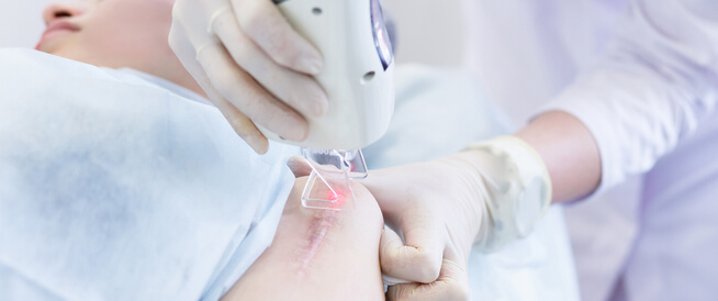 tbl_articles_article_22283_741021417e8-7cf3-47af-916c-13c0cbdb2d7d علاج الندبات بالليزر: معلومات عليك أن تعرفها