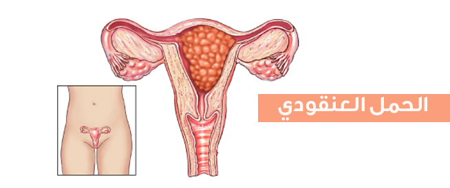 الحمل العنقودي،اسباب اعراض وعلاج الحمل العنقودي