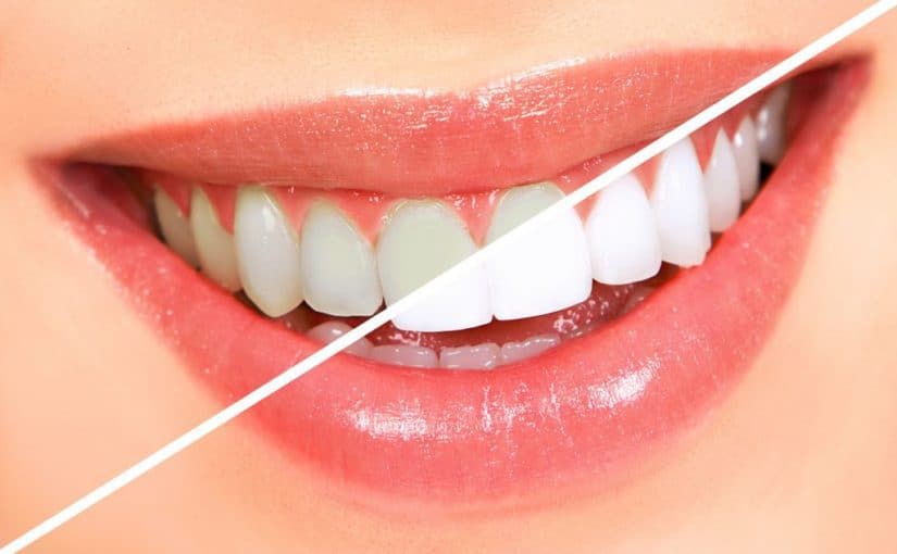 teeth-whitening3-1024x641-825x510-2 عيادة ابتسامات النجوم