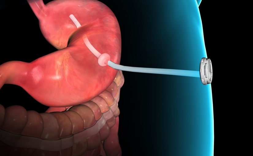 عمليات التكميم