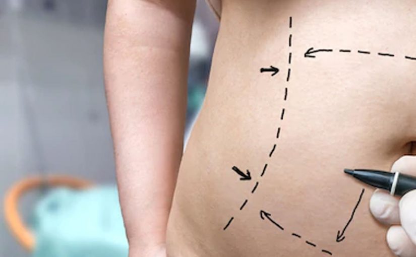 tummy-tuck-825x510-2 شفط الدهون بالفيزر