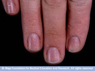 مسمار الإظفر مسمار الإظفر