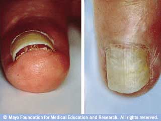 إنفكاك الإظفر إنفكاك الإظفر