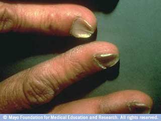 الأظافر المقعرة الأظافر المقعرة