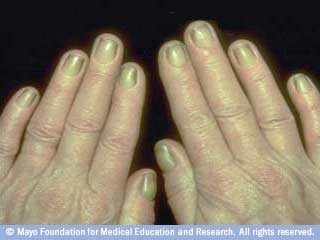 متلازمة الإظفر الأصفر متلازمة الإظفر الأصفر