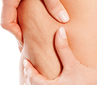 what_is_cellulite-2-380x335-1 1.ما هو السلوليت ؟