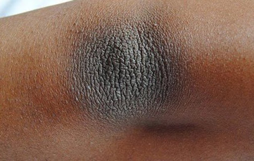 اسمرار الركب