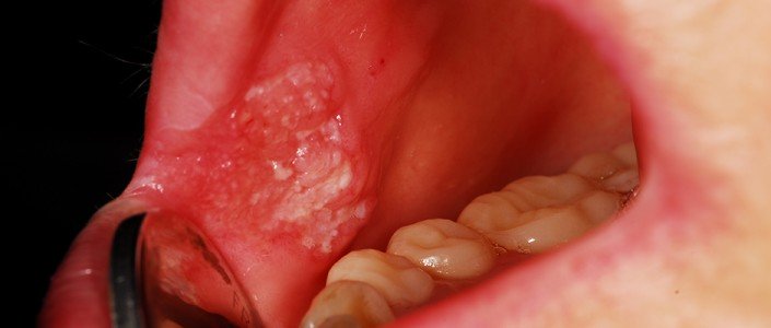 56c1eb37dea77article_944_1-1 سرطــان الفــم واللسـان