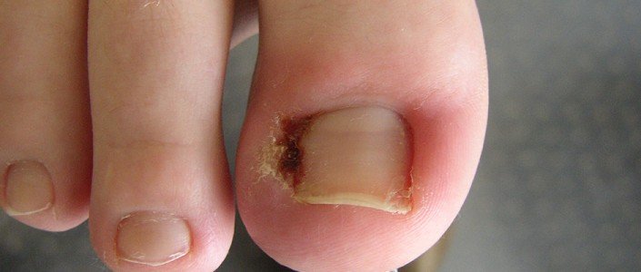 570f8e20d4b26article_1020_1-1 نمو أظفر إصبع القدم للداخل (Ingrown Toenail)