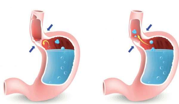 ارتجاع المريء