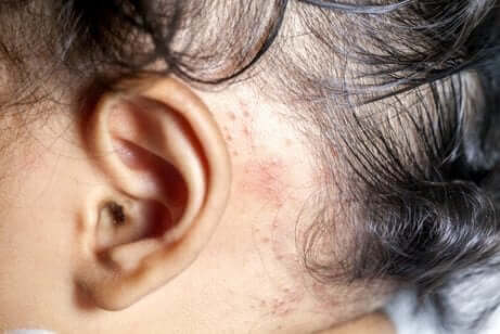 علاج مرض الصدفية في حالة الأطفال