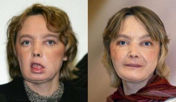 e-4 زراعة الوجه