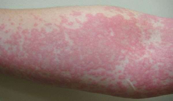 حساسية الماء