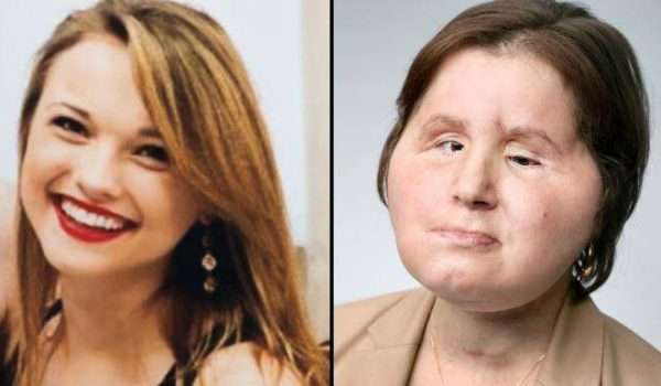 e-5 زراعة الوجه