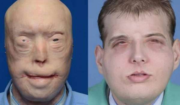 e-6-2 زراعة الوجه