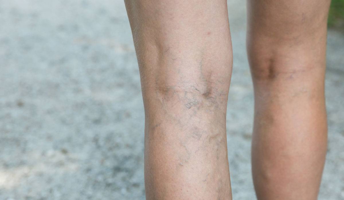 e-9-10 جلطات الدم