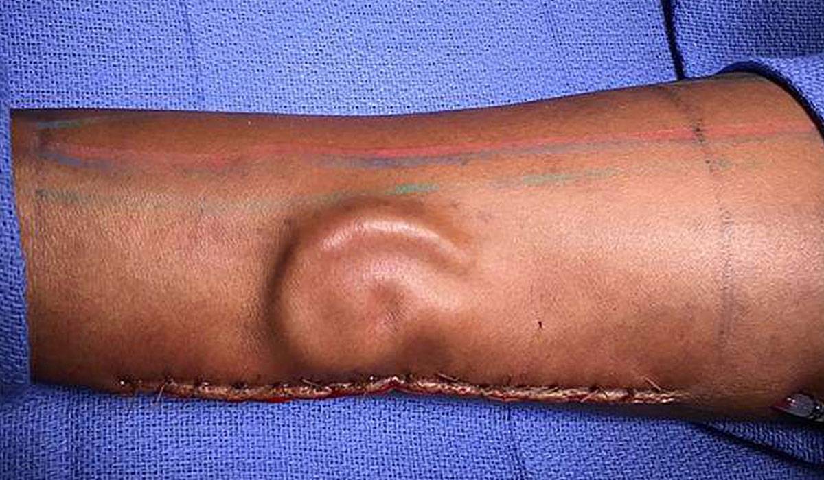 زراعة الاذن