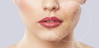 1fa03c01adf1af27e8134612af1066d3-1 طرق التخلص من آثار الحبوب