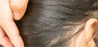 27a0f54765b9c6eff681b32fe20f2d5a-1 علاج القمل بالاعشاب