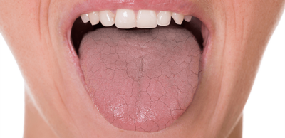 d3bbfff48e8841530fb7aa12e7996c03-1 علاج جفاف الفم بالاعشاب