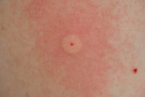 d984d8b3d8b9d8a9 لسعة الدبور الآسيوي