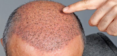 e9cecf8540dc8784b6f6e904217c6fa3-1 زراعة الشعر بالاقتطاف التقنية الواعدة