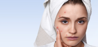 فوائد الزعتر لحب الشباب