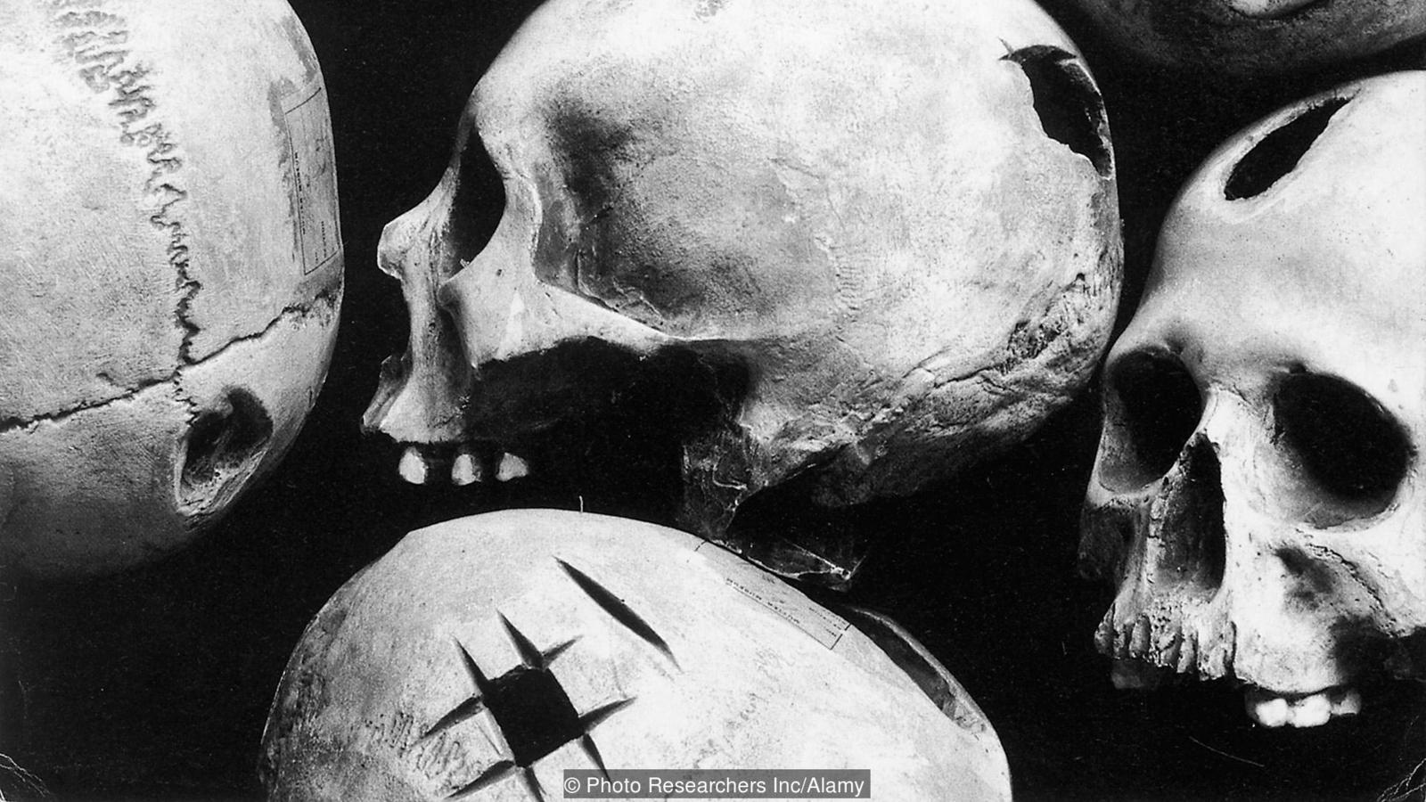 2-d8a7d984d8a5d986d8b3d8a7d986-d8a7d984d982d8afd98ad985-d98ad8abd982d8a8-d8acd985d8acd985d8aad987 الإنسان القديم يثقب جمجمته