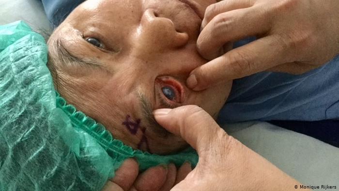 42067885_303 Indonesien Medizin Augen-Katarakt (Monique Rijkers)