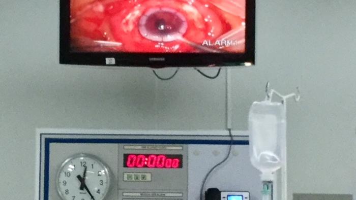 42067906_303 Indonesien Medizin Augen-Katarakt