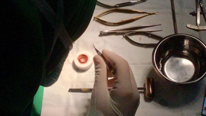 42067920_303 Indonesien Medizin Augen-Katarakt