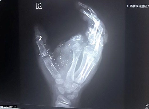 An X-ray shows the boy's index finger was missing after the explosion at his home in China