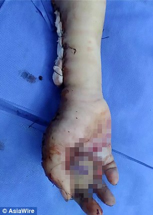 The boy's palm and a number of other digits on his right hand were also left heavily wounded