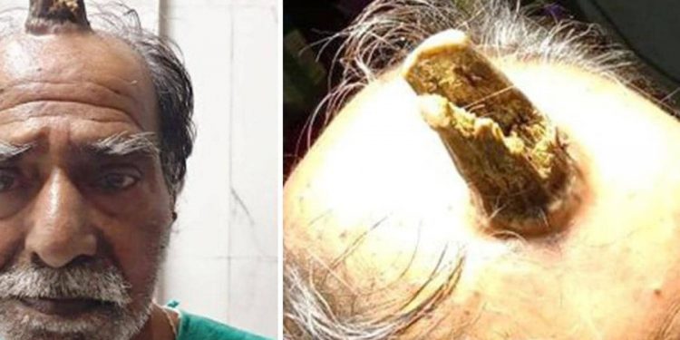 545454-3-750x375-3 بعدما زاد عن حده.. اضطر إلى استئصال “قرن الشيطان”