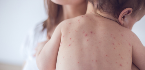 7309cb6ae92005fcc1aeb72c7d116488-1 هل عاد مرض الحصبة للتفشي في العالم وفي الدول العربية