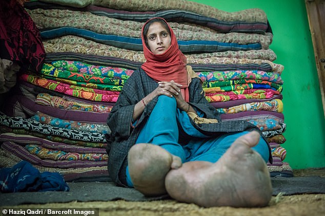 The 21-year-old, who claims she was born with the condition, says she is now housebound