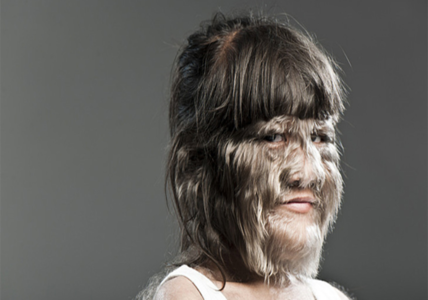 87deb745bcbcc0d1b1a90312e73f5e18-1 جين المستذئبين هو المسؤول عن نمو الشعر الزائد لدى البعض