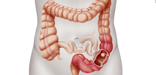 9c34ad68ac408e984bb98584efb58602-1 دور الأسبرين وغيره في الوقاية من سرطان القولون والمستقيم