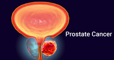 bc1b64266a02b94ff4c49394f981456c-1 الكشف المبكر عن سرطان البروستات
