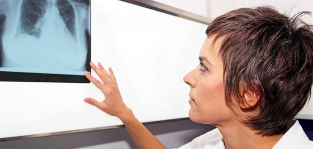 أعراض الجلطة الرئوية أعراض الجلطة الرئوية